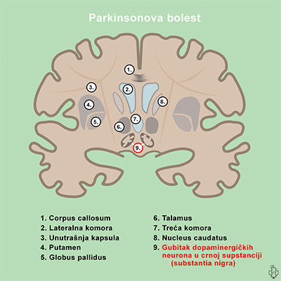 Parkinsonova bolest, dopamin, neuron, diencephalon, medjumozak, parkinson, substantia nigra