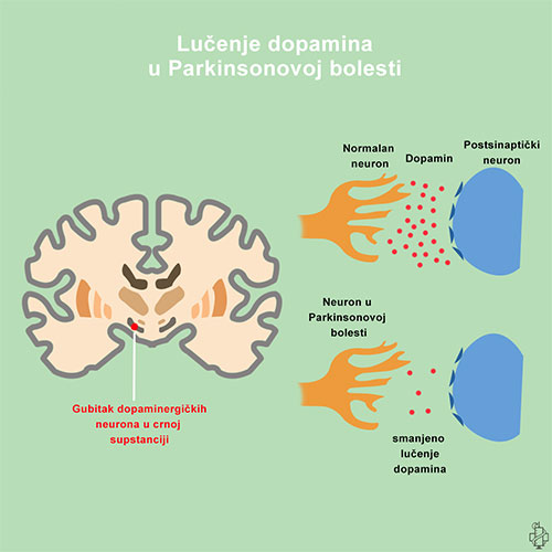 Parkinsonova bolest, dopamin, neuron, diencephalon, medjumozak, parkinson, substantia nigra