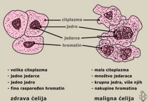 Maligni Tumori - Karakteristike, Građa, Metastaze, Poređenje Sa Benignim